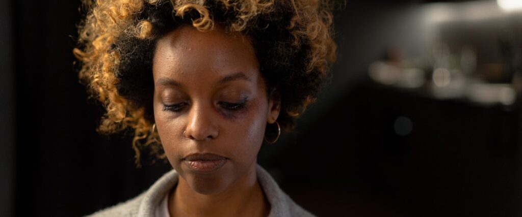 Mulher olhando para baixo, com um olho roxo, após sofrer violência doméstica.